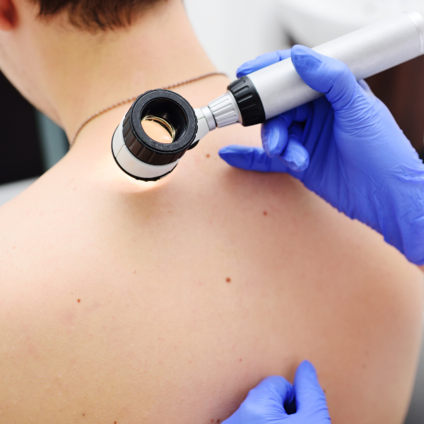 A GP using a dermatoscope to examine a patient's skin